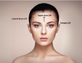 Upper Face Lift