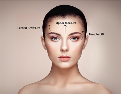 Upper Face Lift