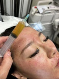 PRP Microneedling